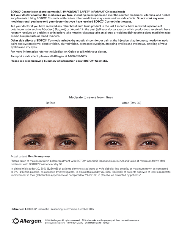 Botox Frown Lines before and after image