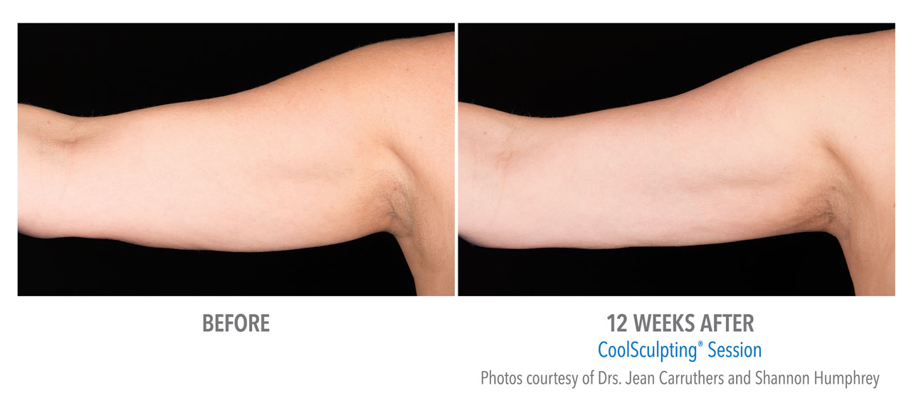CoolSculpting before and after image