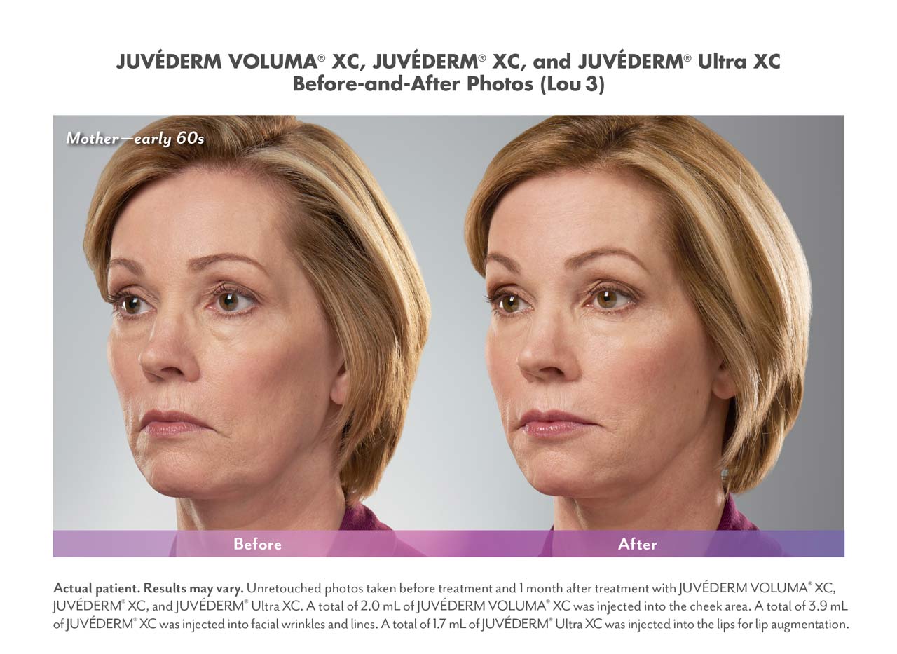 dermal fillers before and after image